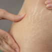 Understanding Stretch Mark Reduction